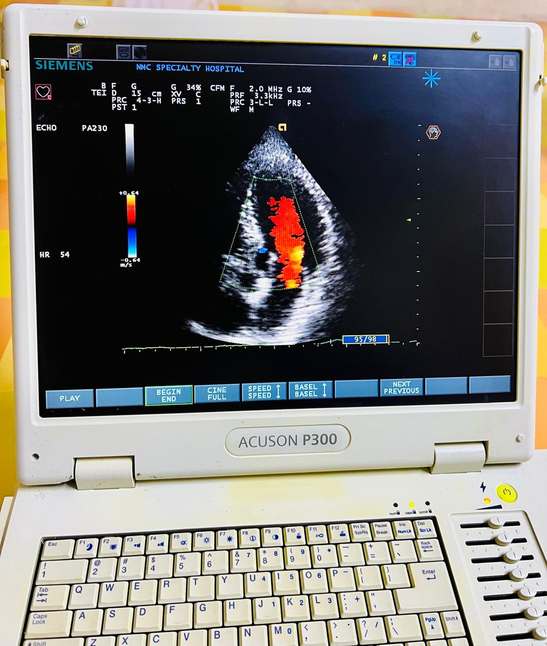 Siemens Acuson P300 portable echo color doppler ultraosund with
adult cardiac probe