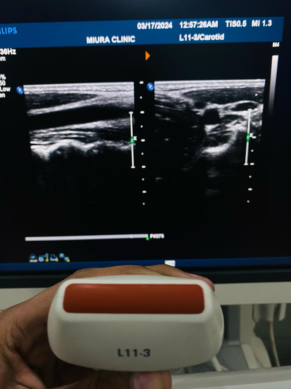 ..Philips L11-3 linear probe