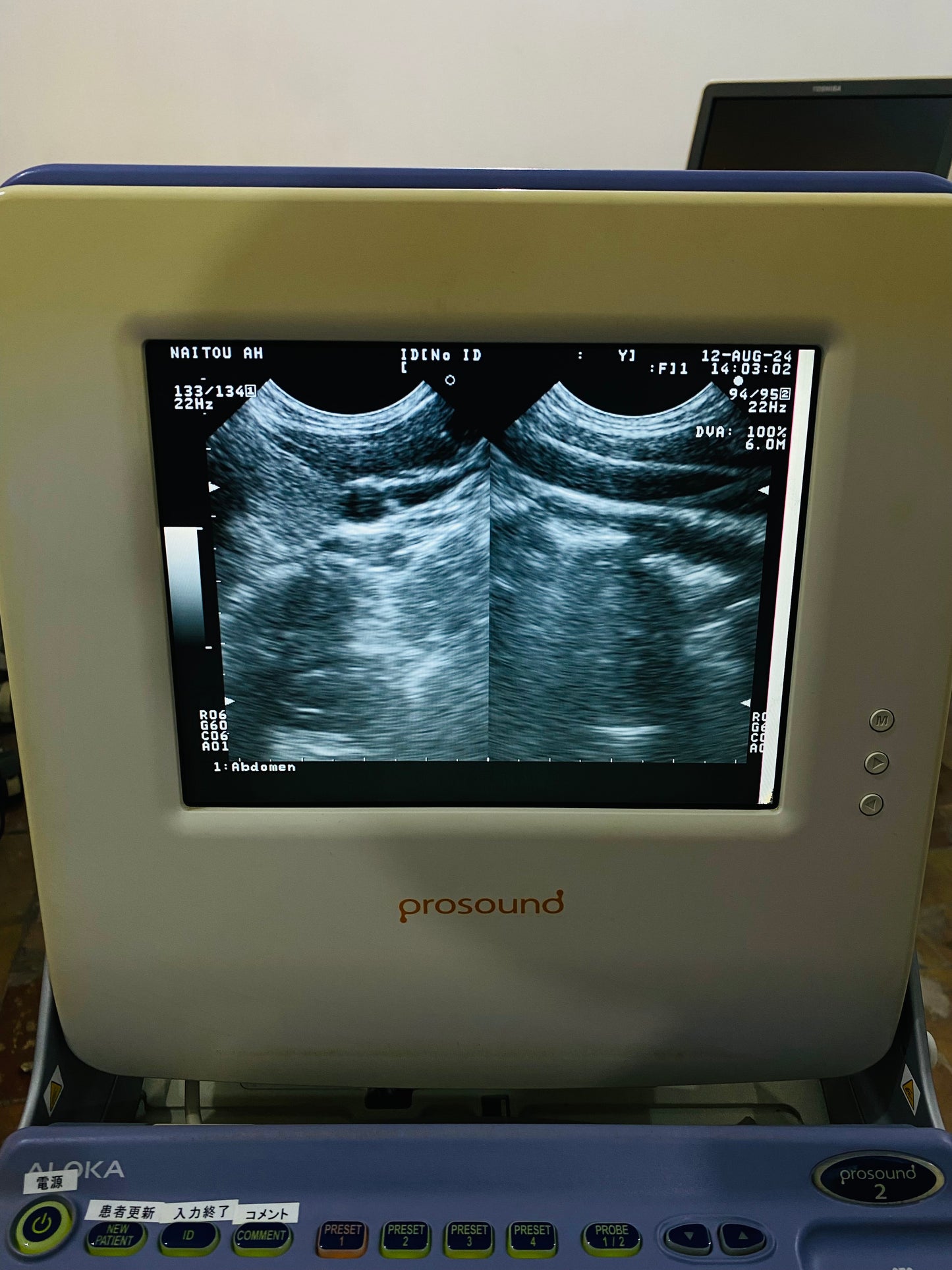 P..Aloka UST-9111-5 Micro convex probe