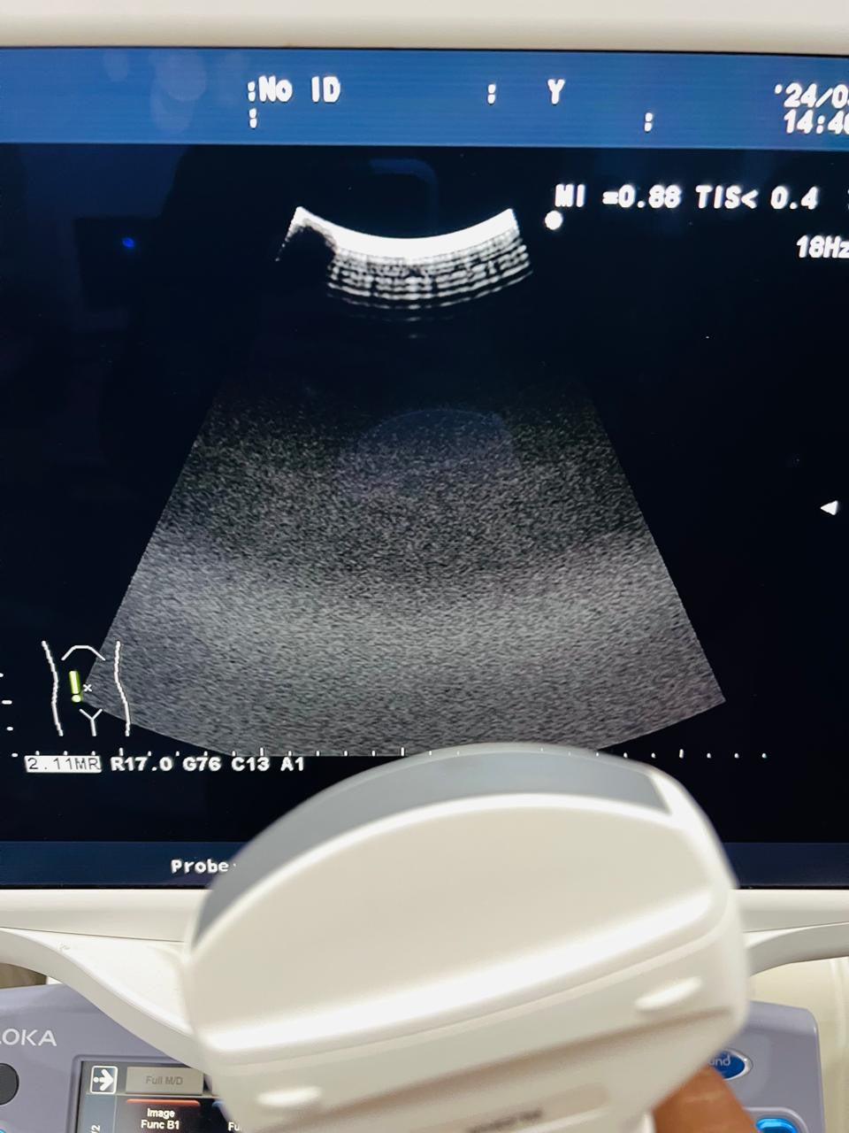 Z..Aloka UST- 9130 Convex Probe