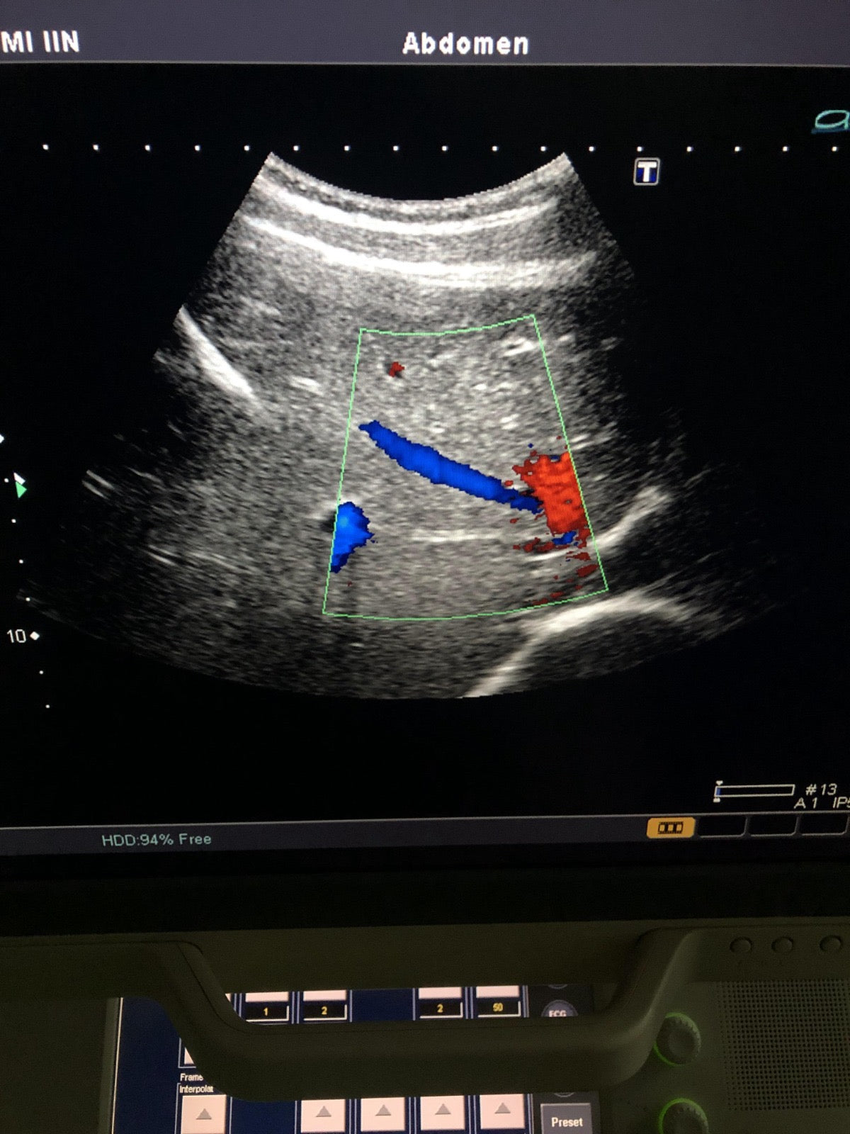 Toshiba PVT-350BT canvex array biopsy transducer probe - Japan Medical Company LTD