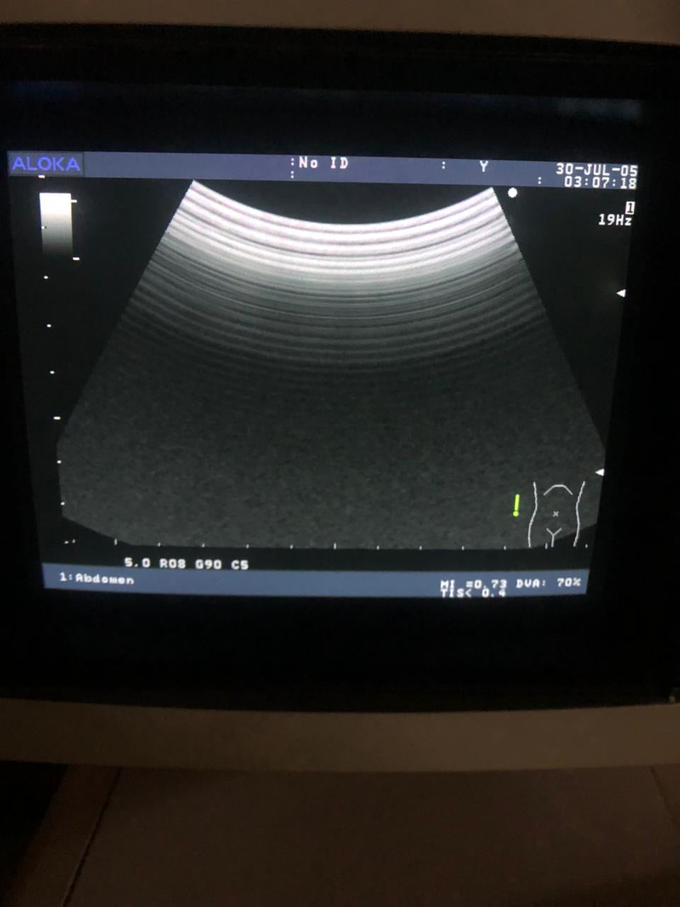..Aloka UST-9126 Convex Probe - Japan Medical Company LTD