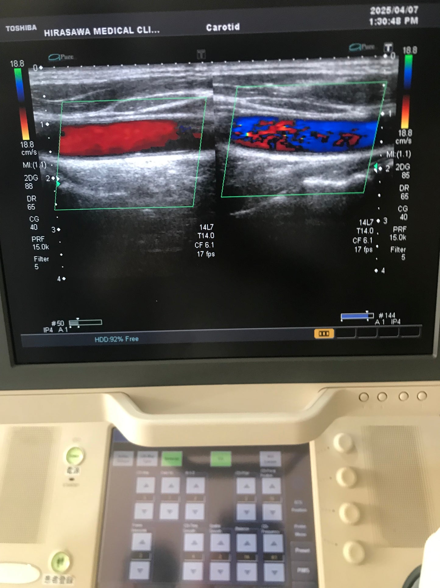 P..Toshiba PLT-1204AT linear probe
