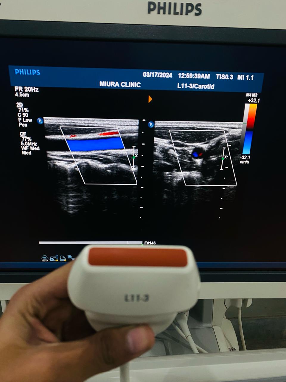 ..Philips L11-3 linear probe