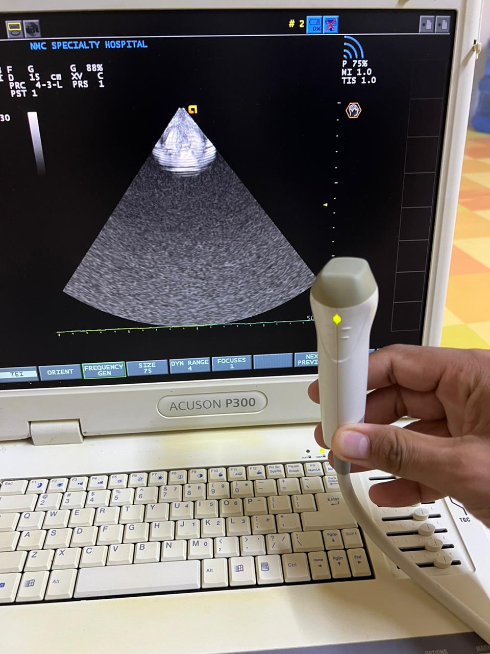 Siemens Acuson P300 portable echo color doppler ultraosund with
adult cardiac probe