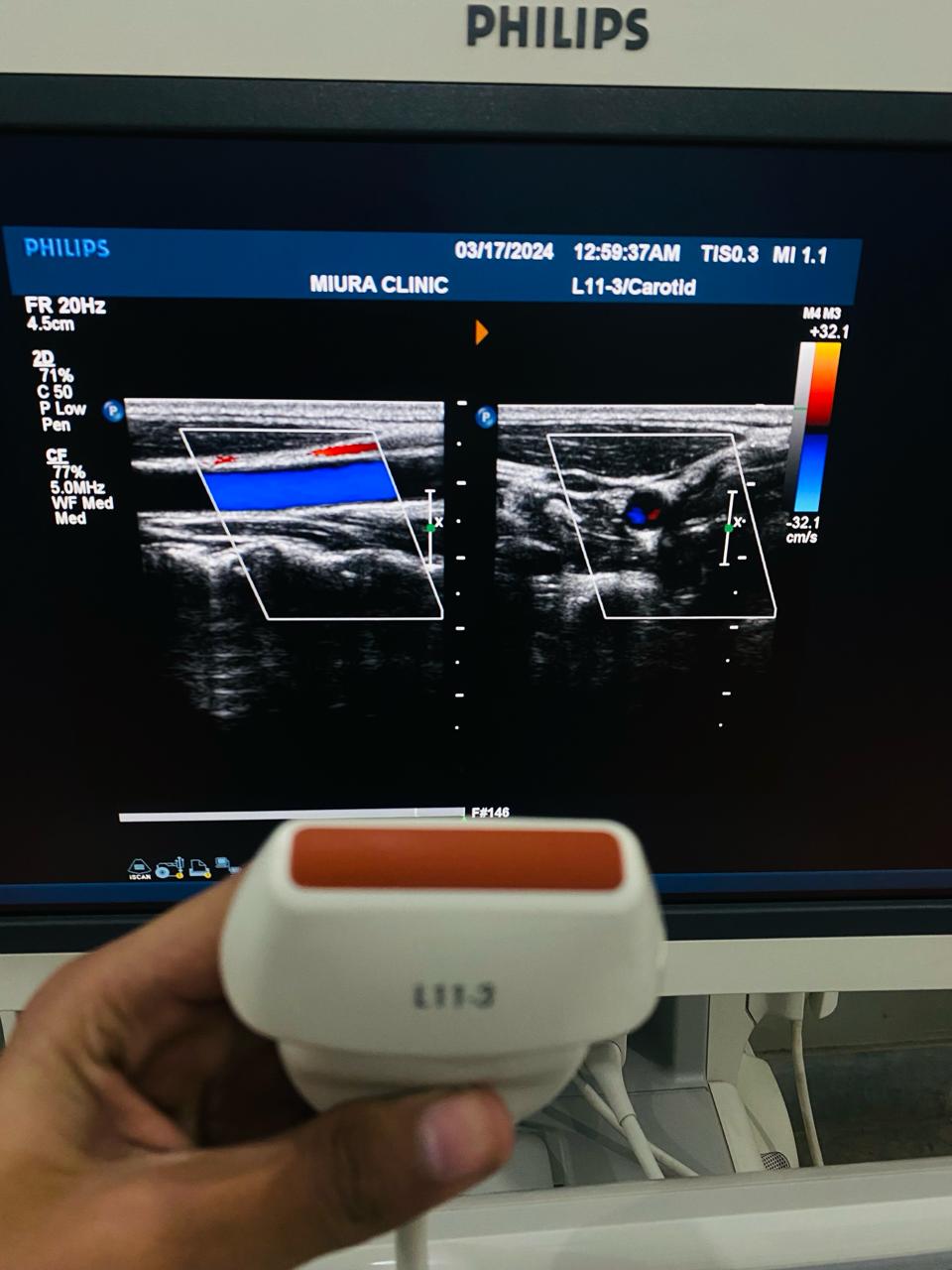 ..Philips L11-3 linear probe
