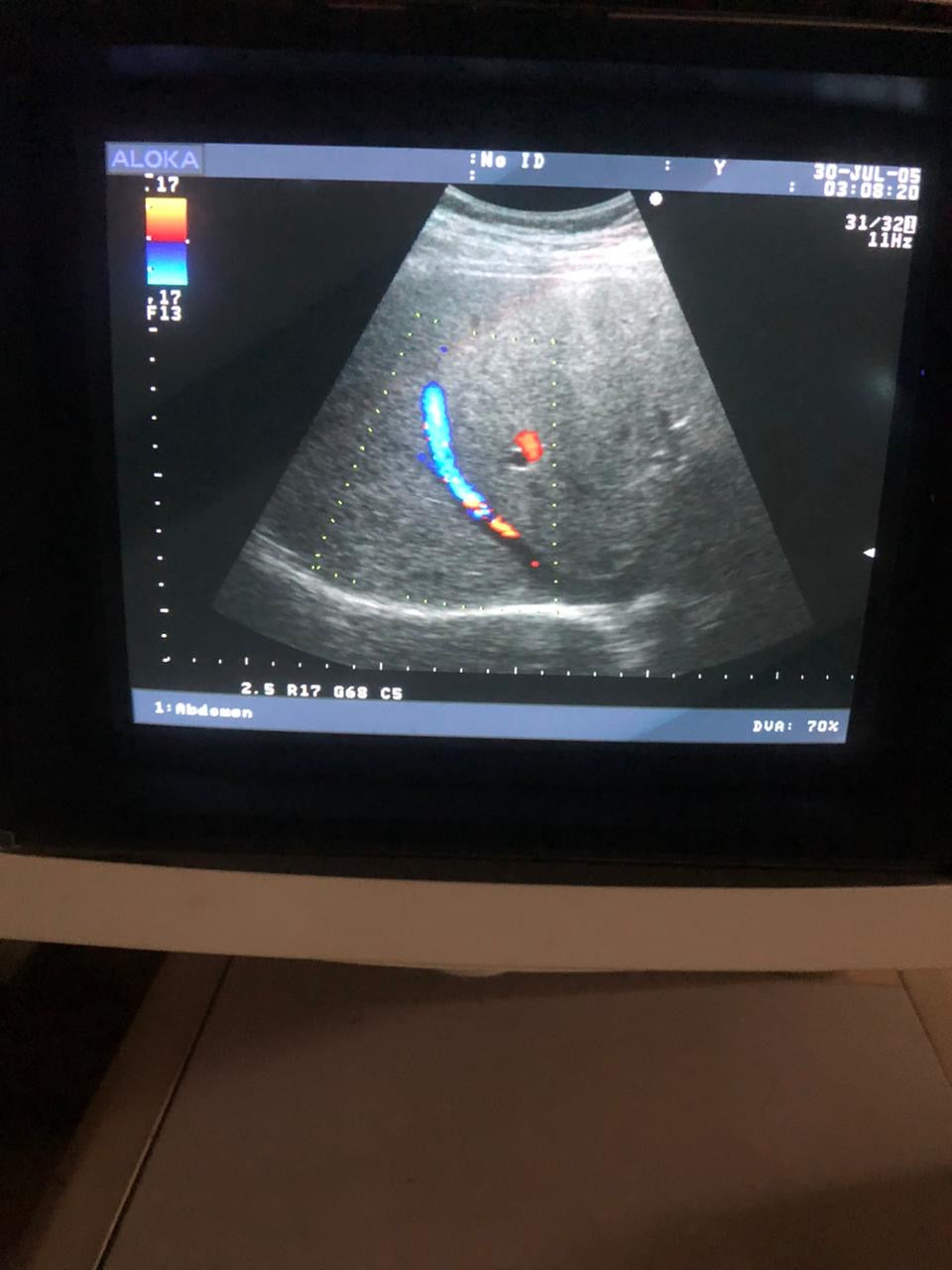 ..Aloka UST-9126 Convex Probe - Japan Medical Company LTD