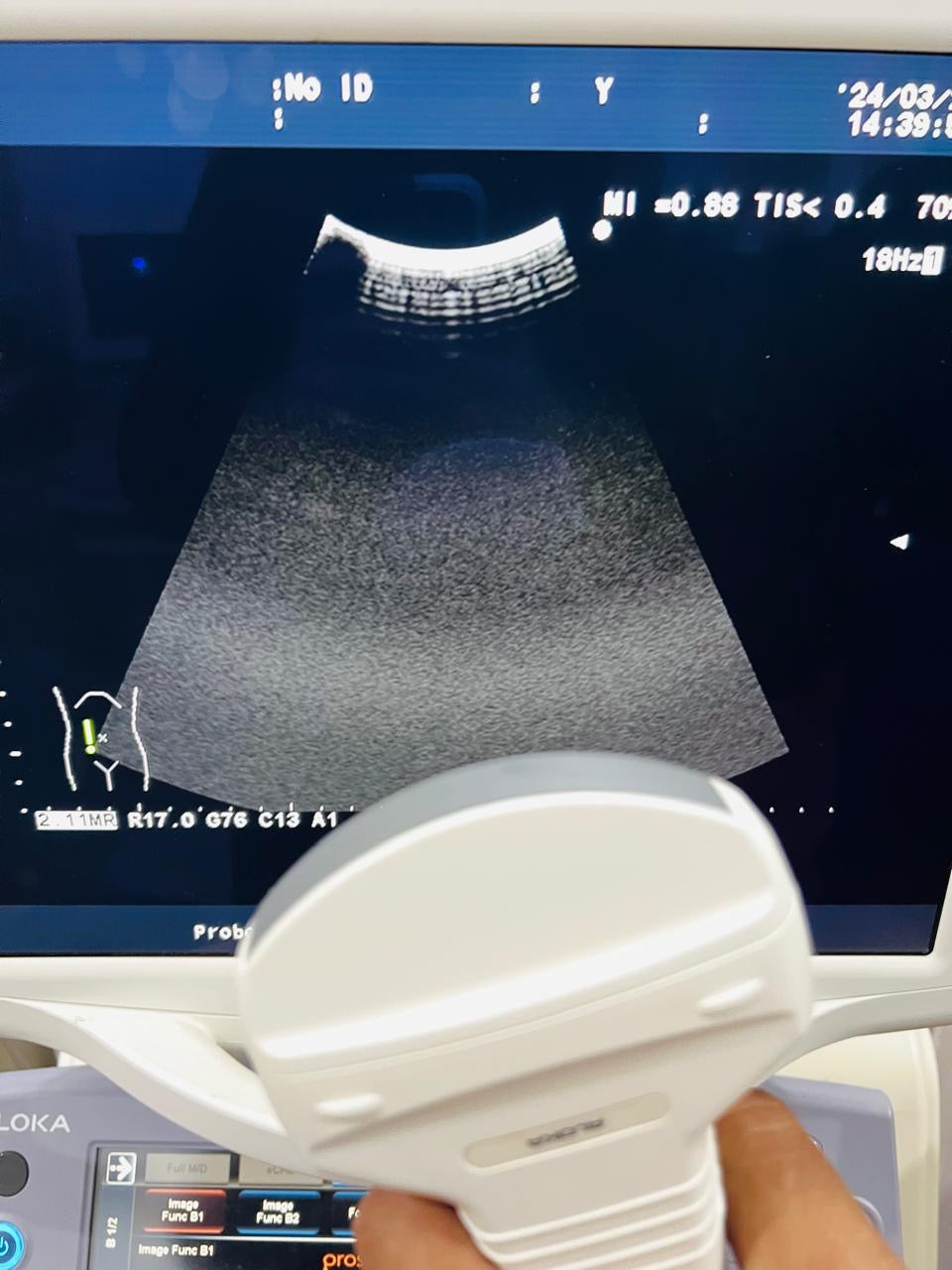 Z..Aloka UST- 9130 Convex Probe