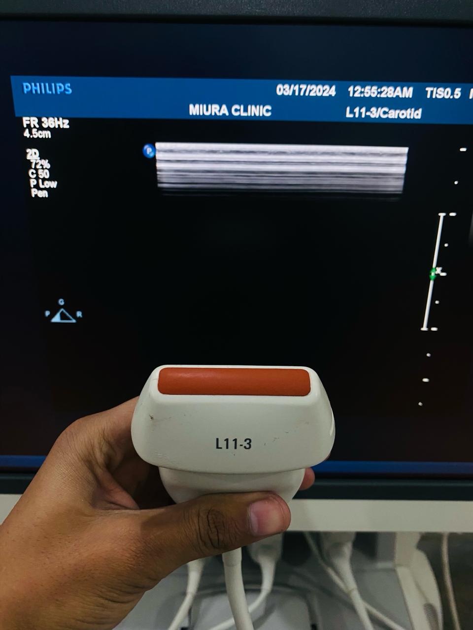 ..Philips L11-3 linear probe