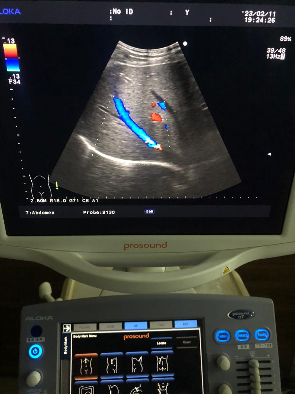 ..Aloka UST-9130 Convex probe - Japan Medical Company LTD