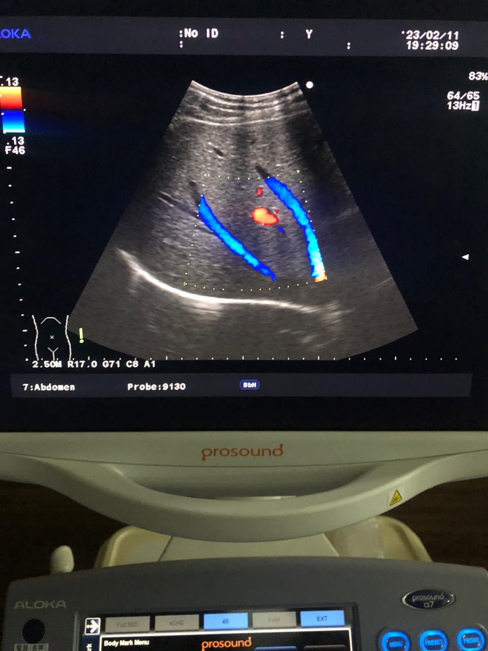 ..Aloka UST-9130 Convex probe - Japan Medical Company LTD