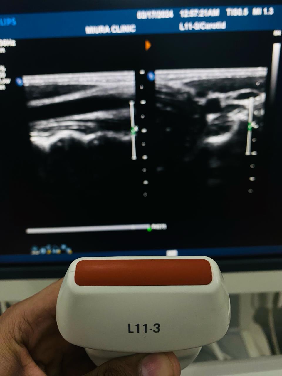..Philips L11-3 linear probe