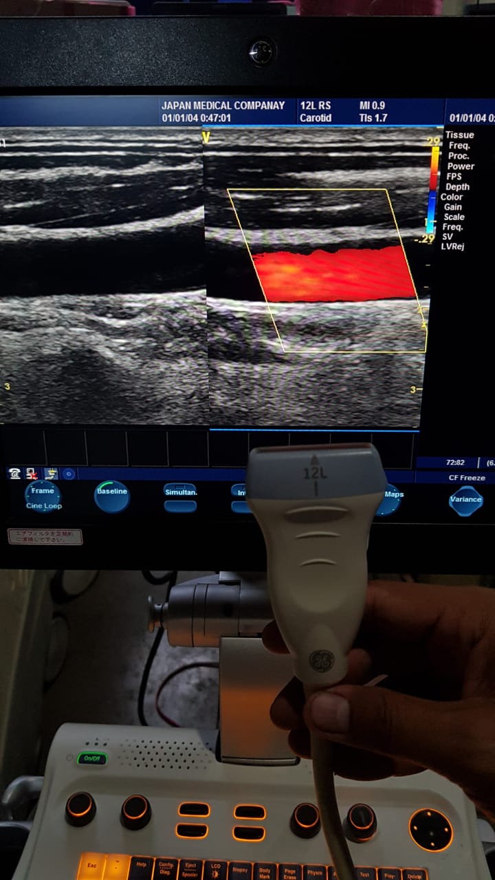GE 12L-RS Mfg: 2012 Linear Vascular Probe