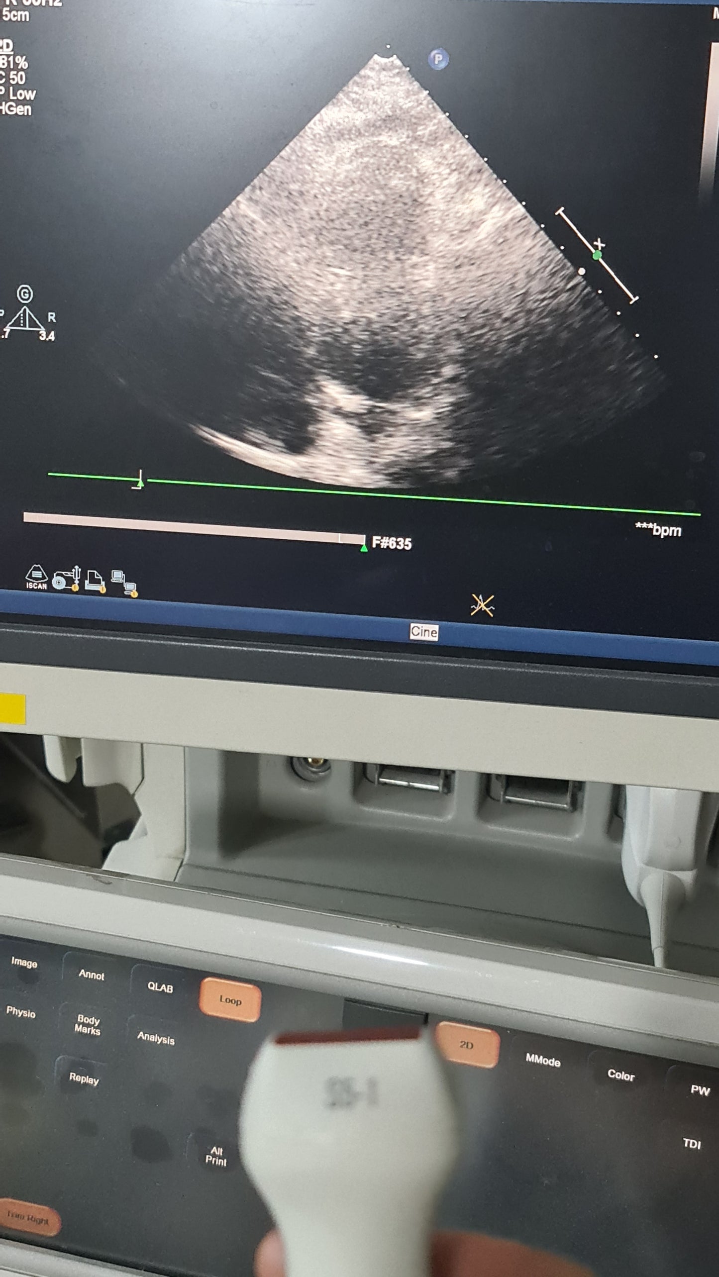 S5-1 philips prob cardiac