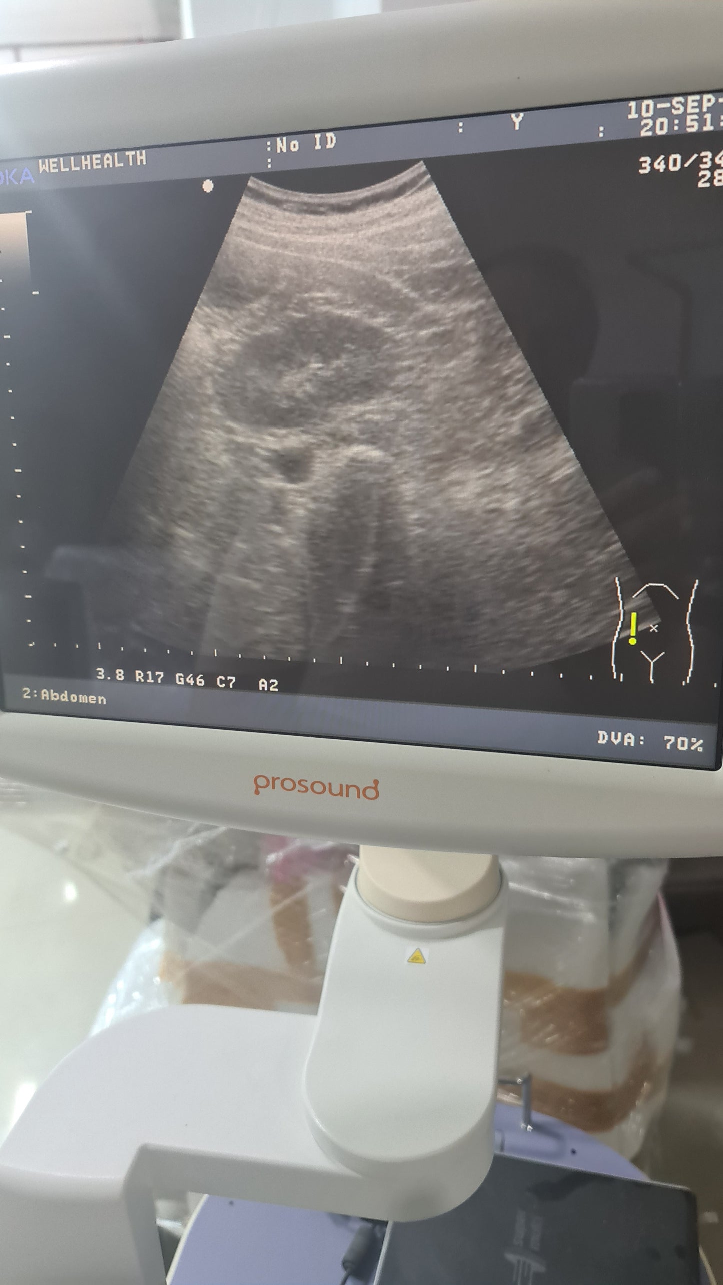 Z..Aloka UST-9123 Convex Probe checked SN V0002986