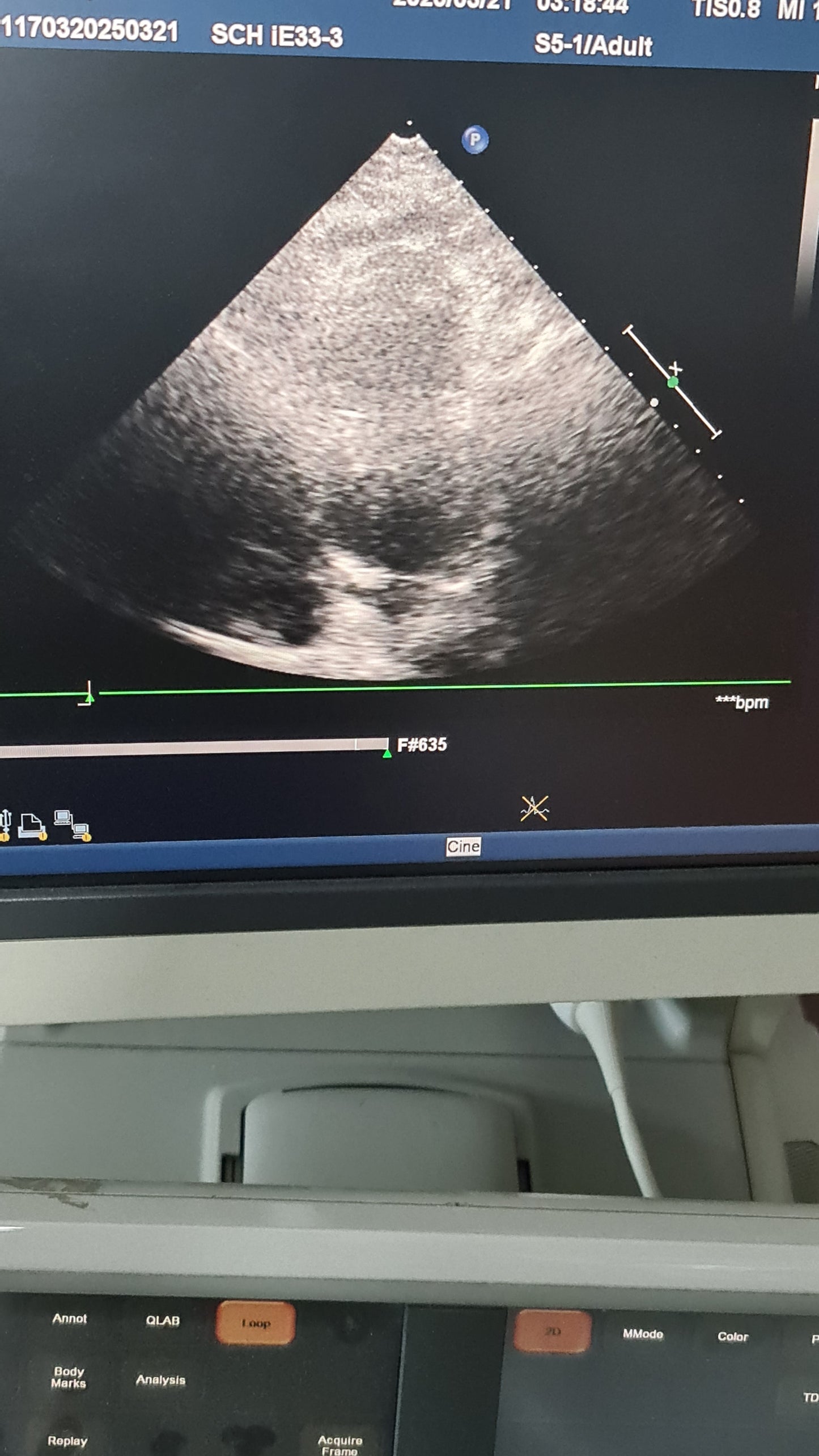 S5-1 philips prob cardiac