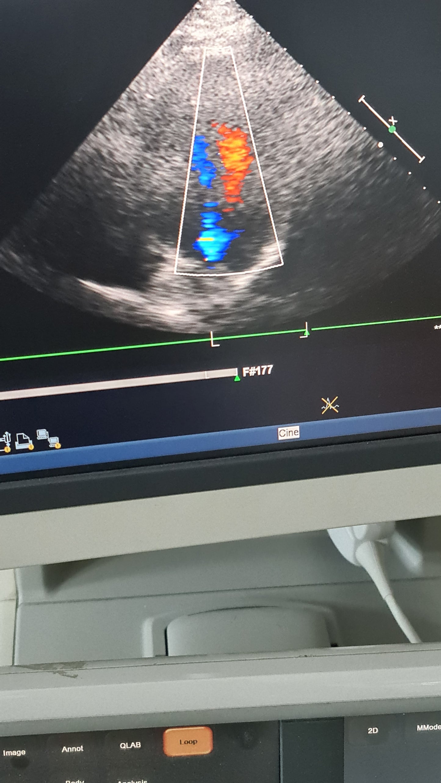 S5-1 philips prob cardiac