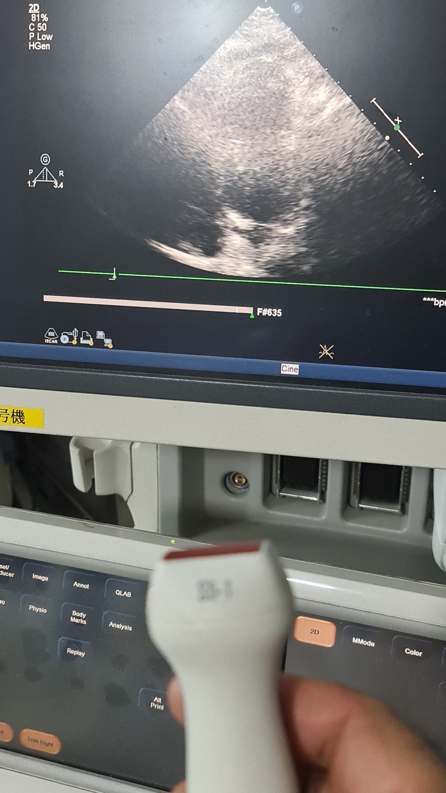 S5-1 philips prob cardiac