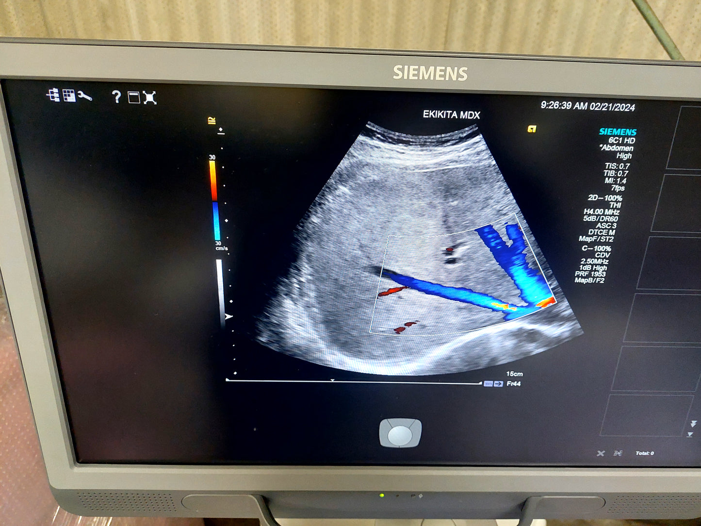 ACUSON S2000 ABVS Ultrasound System, YOM: 2019 HELX Evolution with Touch Control