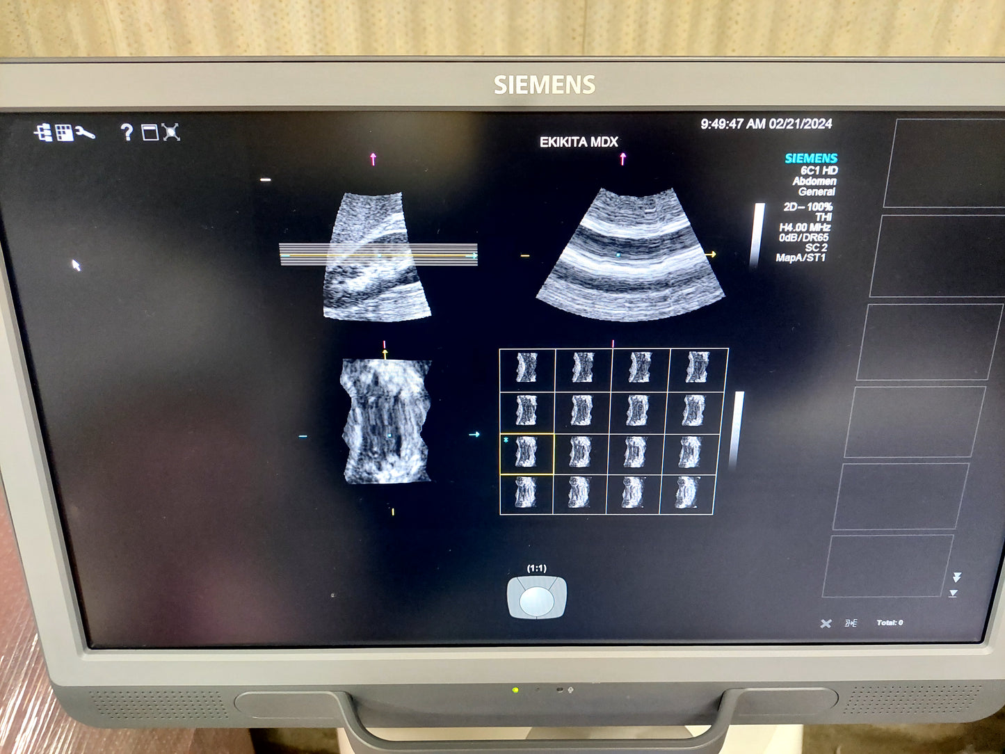 ACUSON S2000 ABVS Ultrasound System, YOM: 2019 HELX Evolution with Touch Control