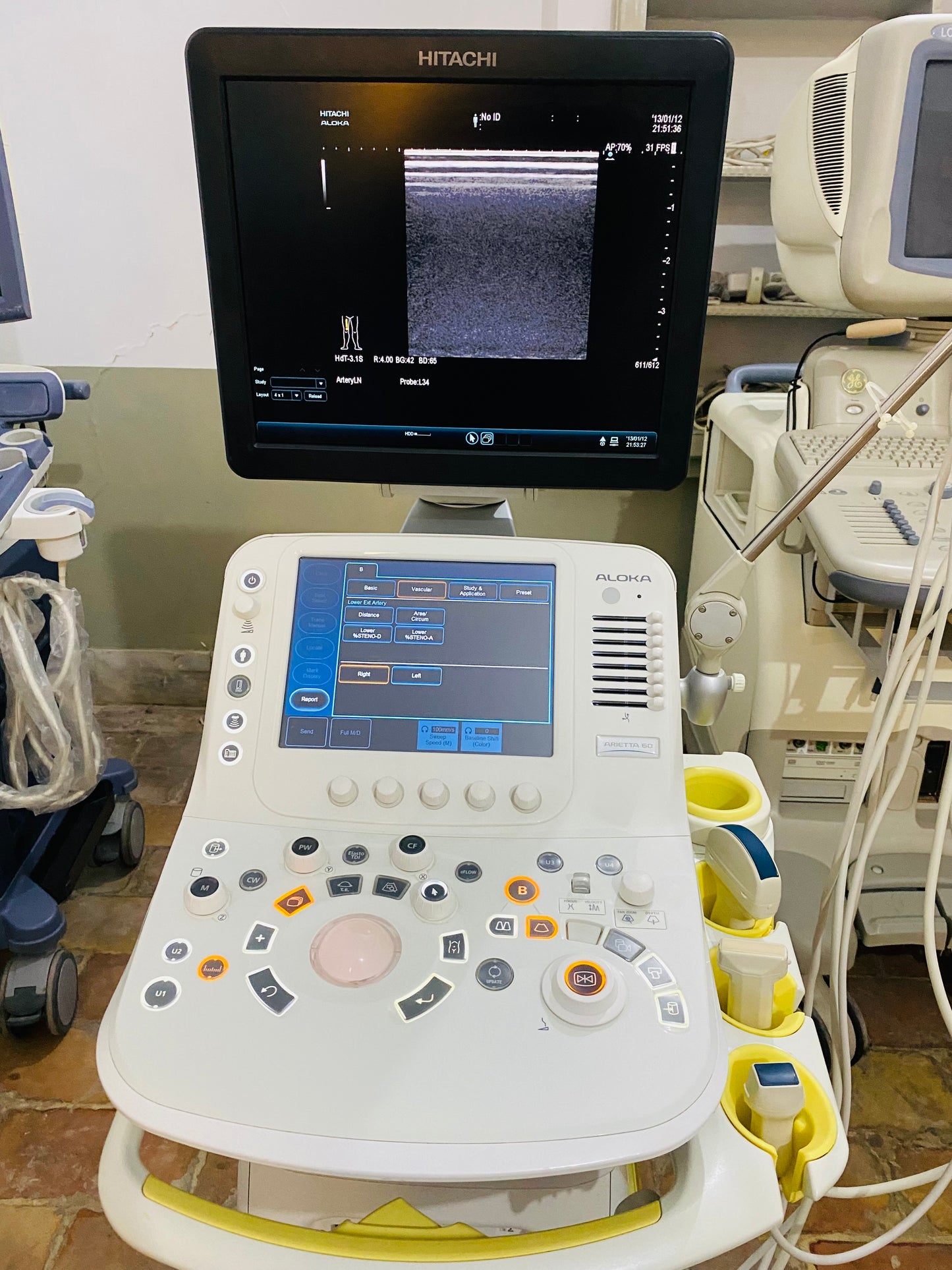 Hitachi Aloka ARIETTA 60 with convex linear cardiac probe, convex probe has air shade. Also can sell it's probes and parts separately