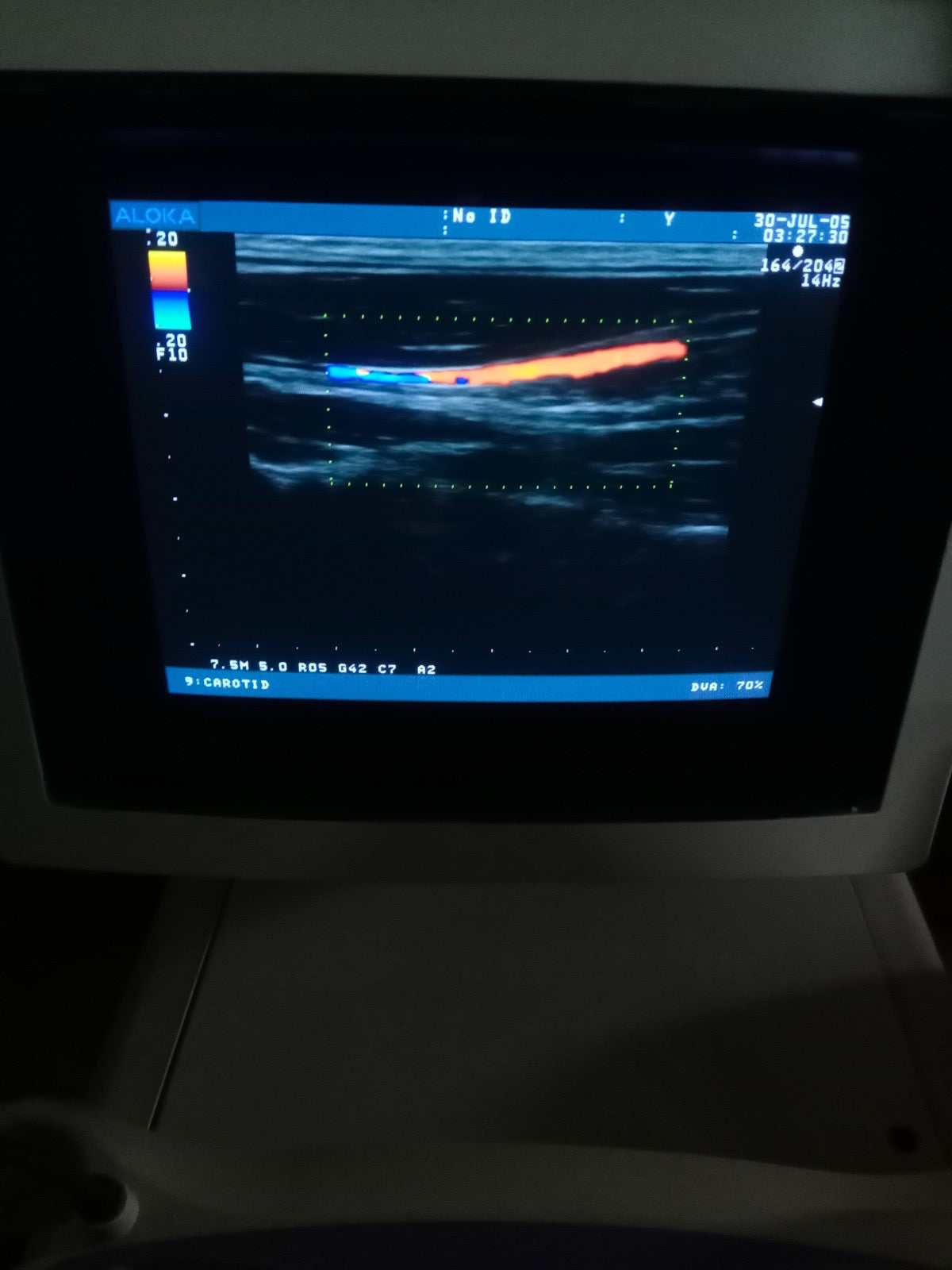 ..Hitachi UST-5710-7.5 linear vascular probe - Japan Medical Company LTD