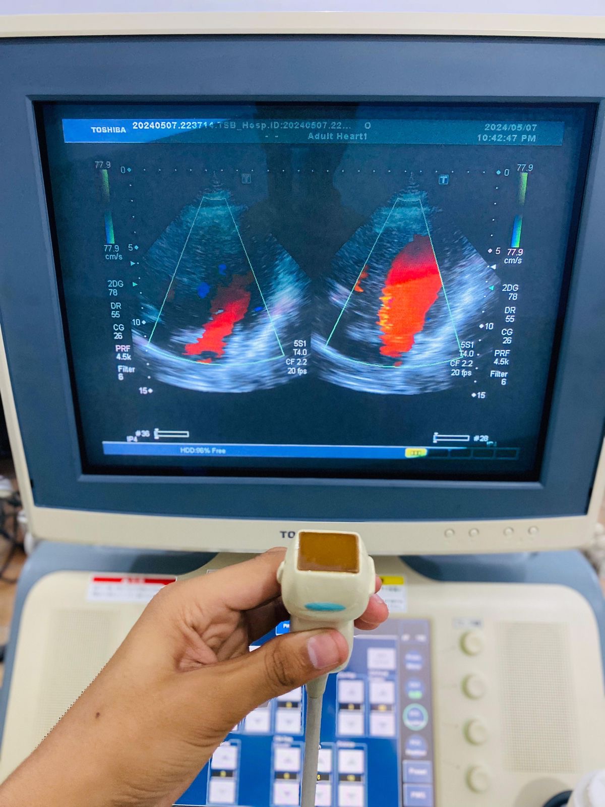 Toshiba Xario prime CRT with adult cardiac probe