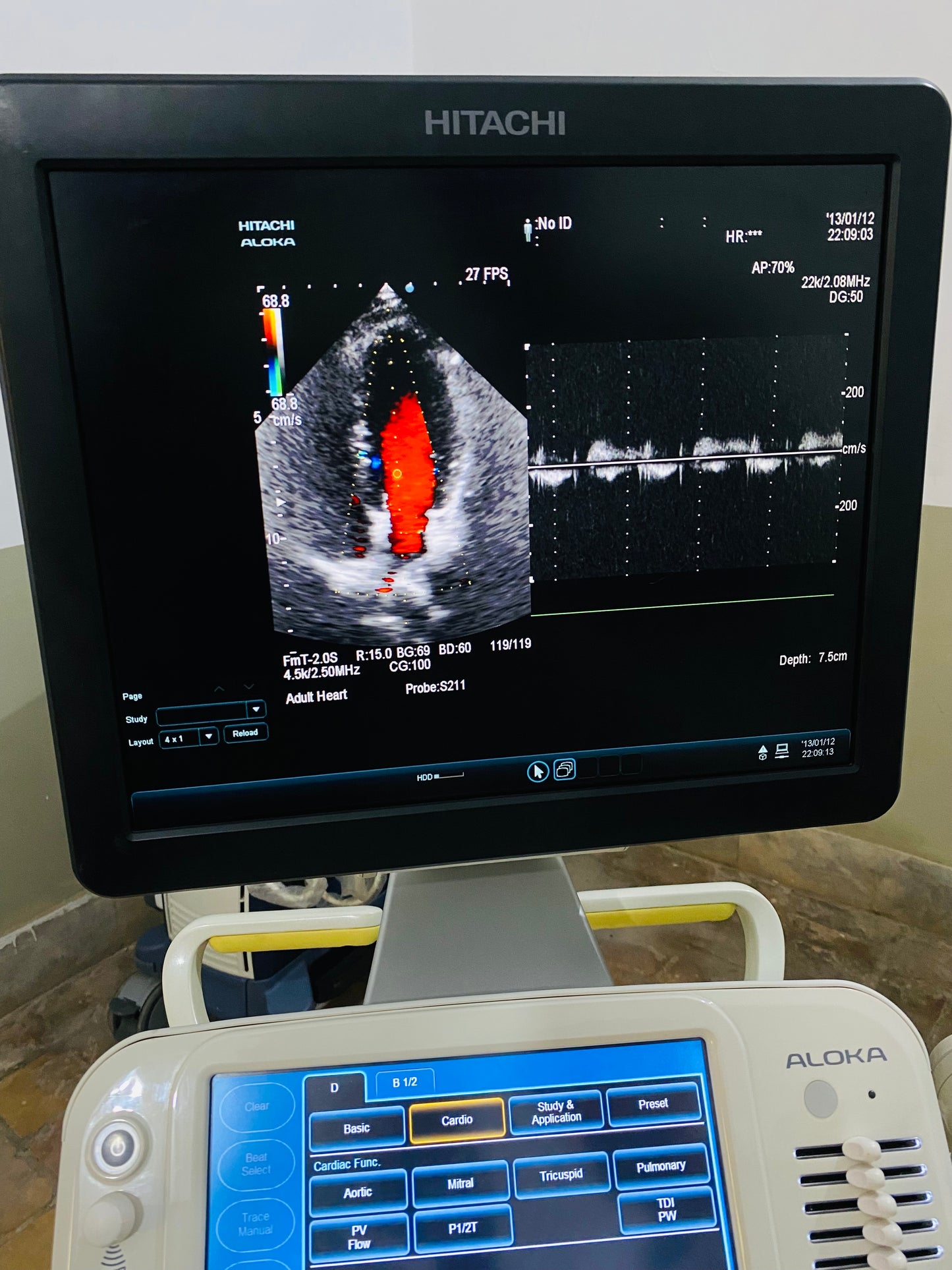 Hitachi Aloka ARIETTA 60 with convex linear cardiac probe, convex probe has air shade. Also can sell it's probes and parts separately