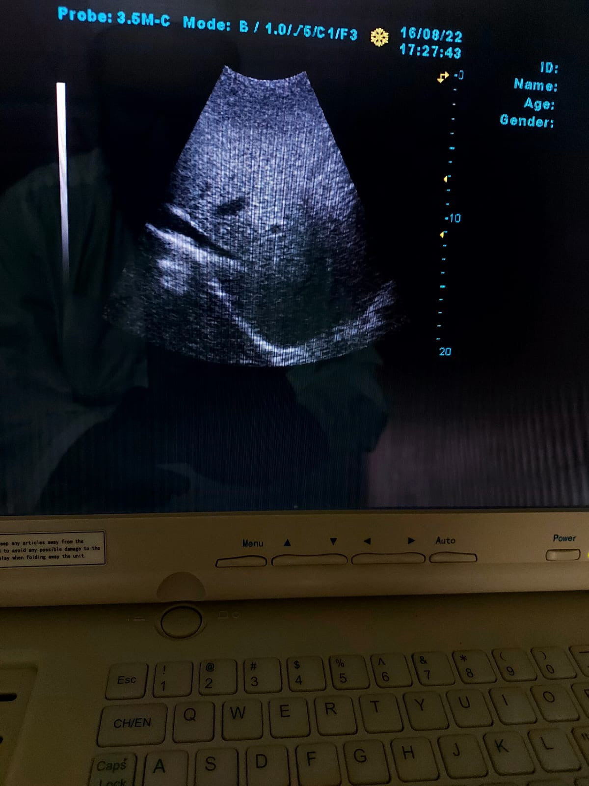 B..Linkton gray scale ultrasound machine, china used with convex probe