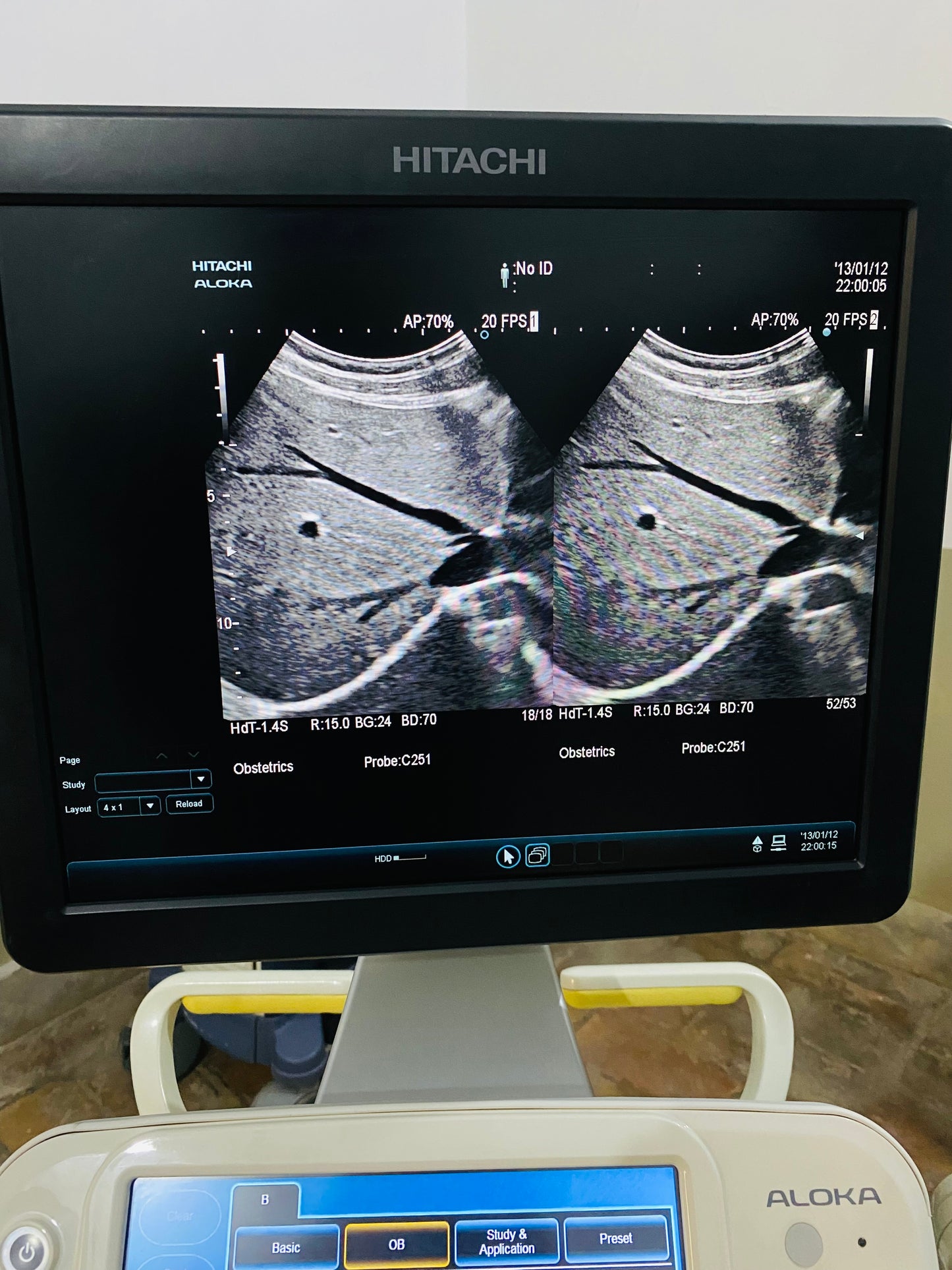 Hitachi Aloka ARIETTA 60 with convex linear cardiac probe, convex probe has air shade. Also can sell it's probes and parts separately