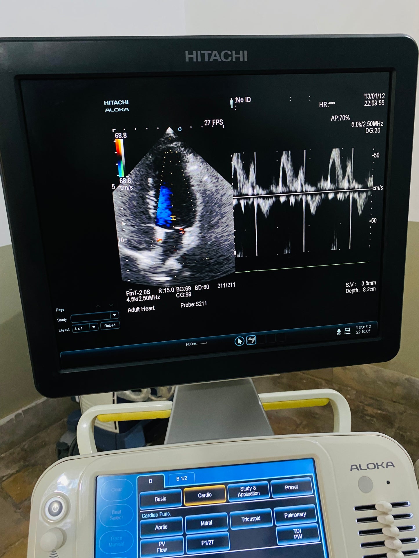 Hitachi Aloka ARIETTA 60 with convex linear cardiac probe, convex probe has air shade. Also can sell it's probes and parts separately