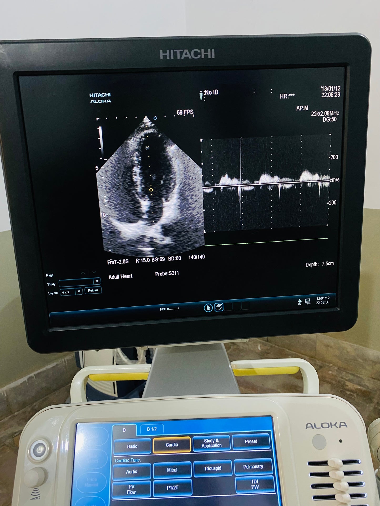 Hitachi Aloka ARIETTA 60 with convex linear cardiac probe, convex probe has air shade. Also can sell it's probes and parts separately