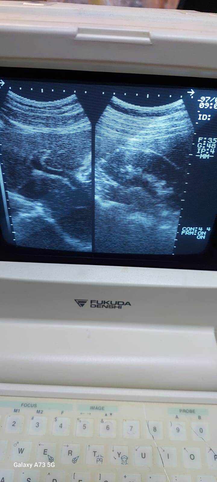 Fukuda Denshi UF-4000 Black and white ultrasound with convex probe