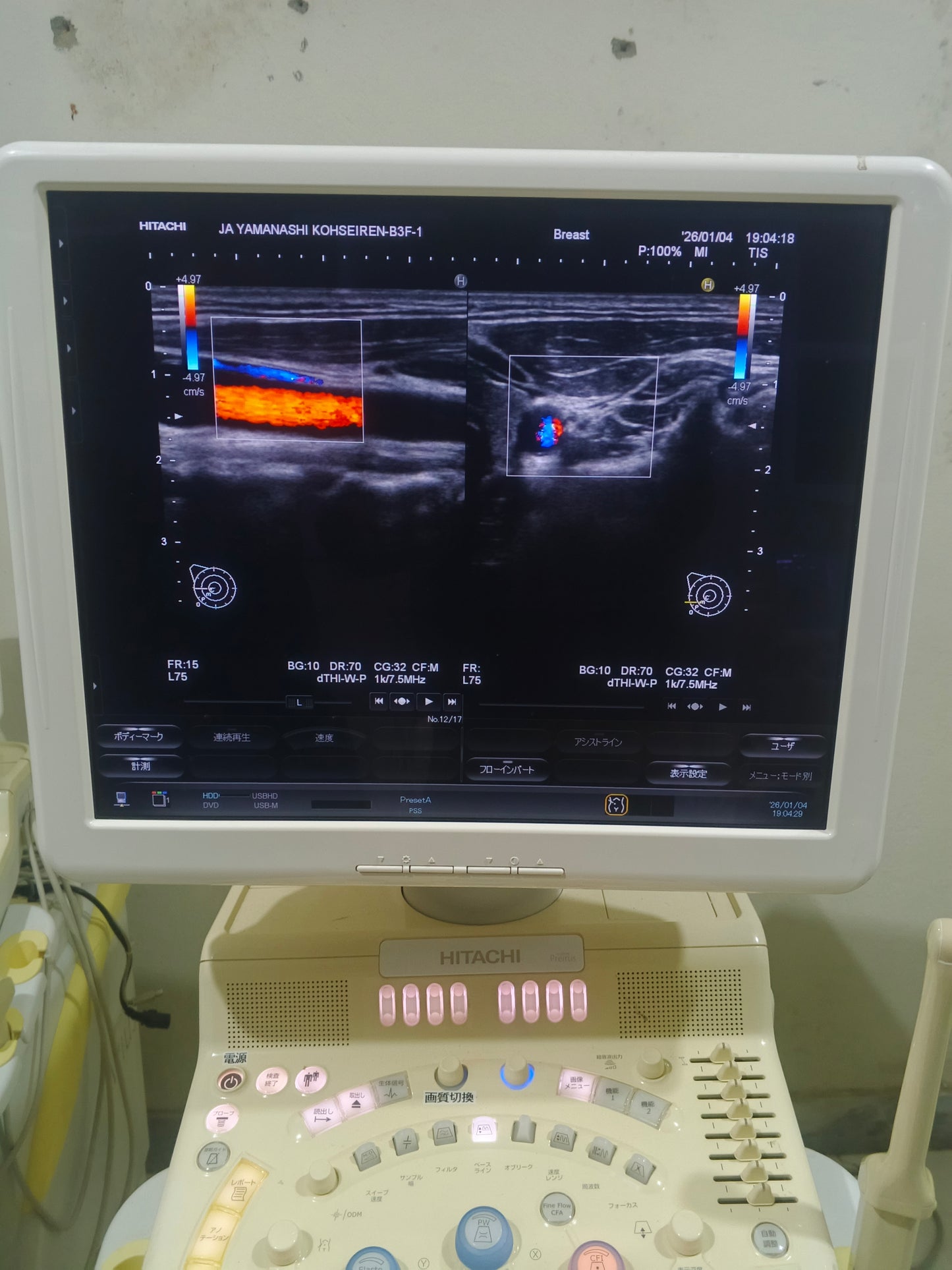 Hitachi avius Linear probe