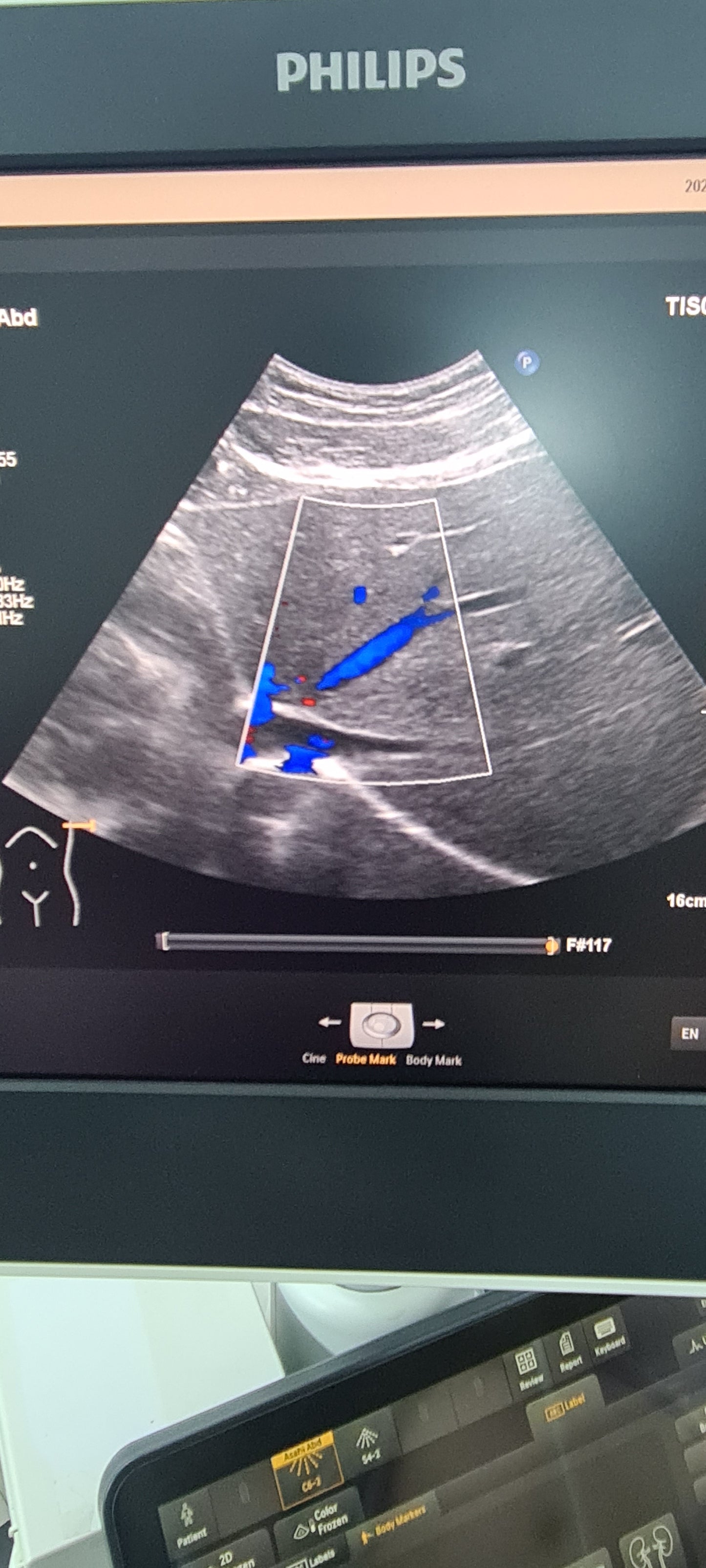 Philips C6-2 Convex probe SN: B16QFF checked DXB