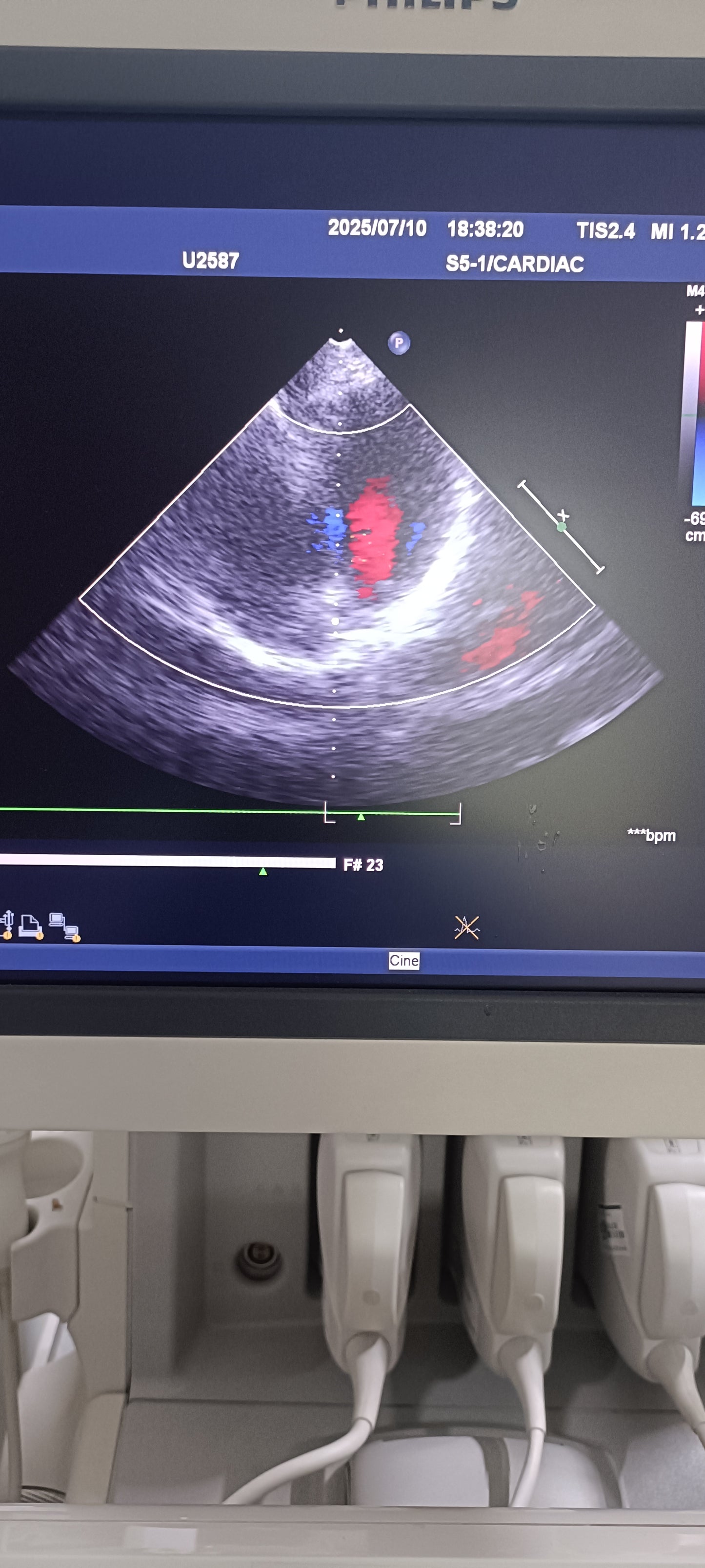 Philips s5-1 cardiac probe sn. 03FG2X checked dxb IS - Japan Medical Company LTD